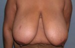 Breast Reduction