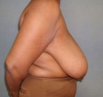Breast Reduction