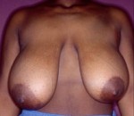 Breast Reduction