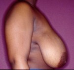 Breast Reduction