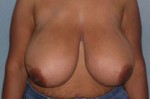 Breast Reduction