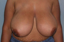 Breast Reduction Case 1058 Before Photo Breast Reduction