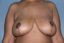 Breast Reduction Before and After Photos | Dr. Balakhani