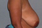 Breast Reduction