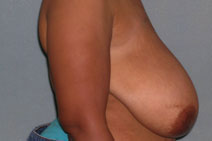Breast Reduction Case 1058 Before Photo Breast Reduction