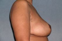 Breast Reduction Before and After Photos | Dr. Balakhani