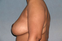 Breast Reduction Case 1058 After Photo Breast Reduction
