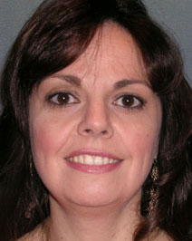 Chin Augmentation Case 3153 Before Photo Chin Augmentation