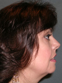 Chin Augmentation Before and After Photos