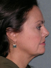 Chin Augmentation Before and After Photos