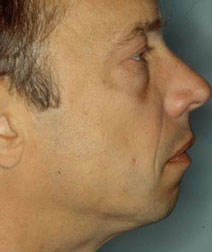 Chin Augmentation Before and After Photos