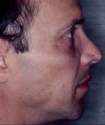 Chin Augmentation