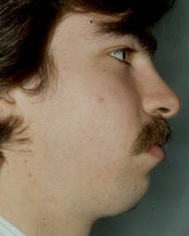 Chin Augmentation