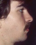 Chin Augmentation