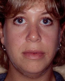 Chin Augmentation Case 3151 Before Photo Chin Augmentation