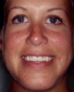 Chin Augmentation