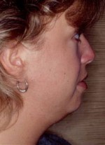 Chin Augmentation