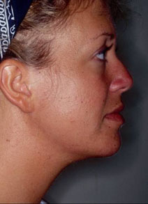 Chin Augmentation Before and After Photos