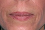 Dermal Fillers