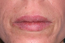 Dermal Fillers Before and After Photos