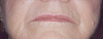 Dermal Fillers Before and After Photos