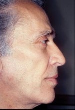 Dermal Fillers