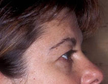 Endoscopic Forehead Lift Case 3182 Before Photo Endoscopic Forehead Lift