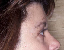 Endoscopic Forehead Lift Before and After Photos