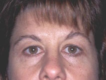 Endoscopic Forehead Lift Before and After Photos