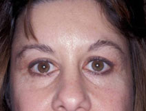 Endoscopic Forehead Lift Case 3182 After Photo Endoscopic Forehead Lift