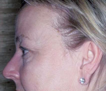 Endoscopic Forehead Lift