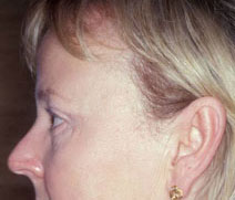 Endoscopic Forehead Lift Case 3187 After Photo Endoscopic Forehead Lift