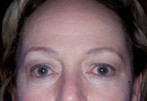 Endoscopic Forehead Lift Case 3187 Before Photo Endoscopic Forehead Lift
