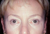 Endoscopic Forehead Lift Before and After Photos