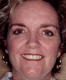 Endoscopic Forehead Lift Case 1068 After Photo Endoscopic Forehead Lift