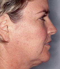 Endoscopic Forehead Lift Case 1068 Before Photo Endoscopic Forehead Lift