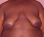 Male Breast Reduction