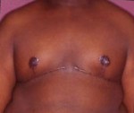 Male Breast Reduction