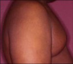 Male Breast Reduction