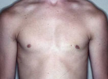 Male Breast Reduction Before and After Photos | Dr. Balakhani