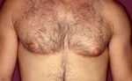 Male Breast Reduction
