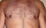 Male Breast Reduction