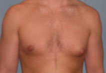 Male Breast Reduction Before and After Photos | Dr. Balakhani