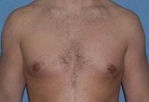 Male Breast Reduction Before and After Photos | Dr. Balakhani