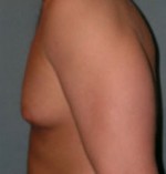 Male Breast Reduction