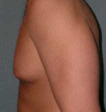 Male Breast Reduction Before and After Photos | Dr. Balakhani
