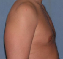 Male Breast Reduction Before and After Photos | Dr. Balakhani