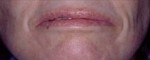 Lip Extension Surgery