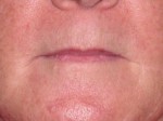 Lip Extension Surgery