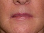 Lip Extension Surgery